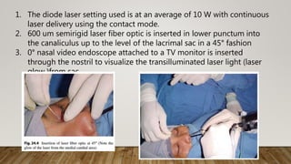 1. The diode laser setting used is at an average of 10 W with continuous
laser delivery using the contact mode.
2. 600 um semirigid laser fiber optic is inserted in lower punctum into
the canaliculus up to the level of the lacrimal sac in a 45° fashion
3. 0° nasal video endoscope attached to a TV monitor is inserted
through the nostril to visualize the transilluminated laser light (laser
glow )from sac
 