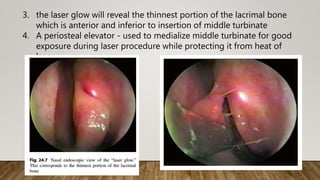 3. the laser glow will reveal the thinnest portion of the lacrimal bone
which is anterior and inferior to insertion of middle turbinate
4. A periosteal elevator - used to medialize middle turbinate for good
exposure during laser procedure while protecting it from heat of
laser
 