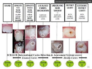 International Caries Detection and Assessment System (ICDAS)

31

 