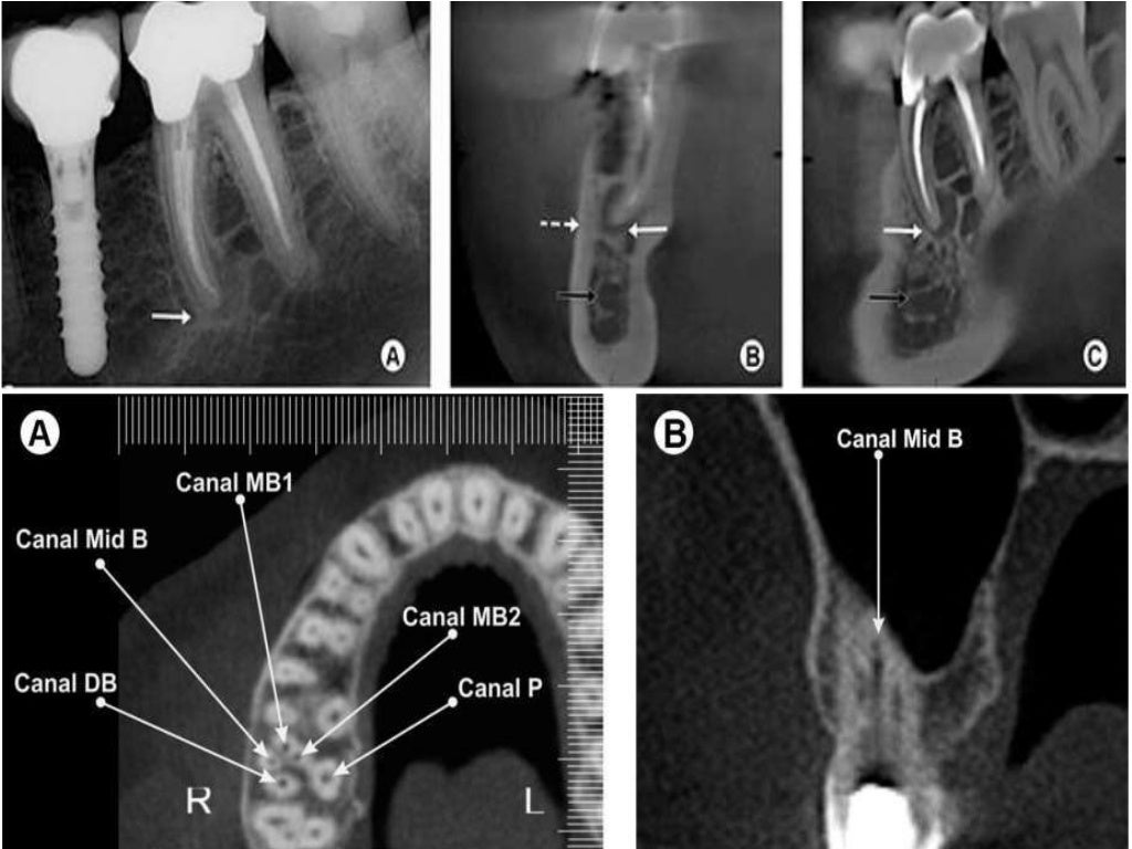 Recent advances in endodontics