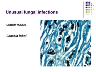 Recent advances in fungal infections | PPT