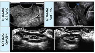 NORMALOVARY
NORMAL
CERVIX
NORMAL
OVARY
NORMAL
VAGINA
 