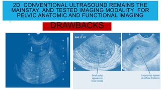 2D CONVENTIONAL ULTRASOUND REMAINS THE
MAINSTAY AND TESTED IMAGING MODALITY FOR
PELVIC ANATOMIC AND FUNCTIONAL IMAGING
DRAWBACKS
 
