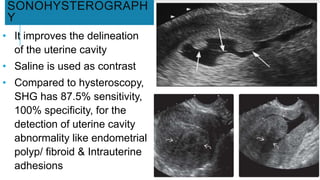 SONOHYSTEROGRAPH
Y
• It improves the delineation
of the uterine cavity
• Saline is used as contrast
• Compared to hysteroscopy,
SHG has 87.5% sensitivity,
100% specificity, for the
detection of uterine cavity
abnormality like endometrial
polyp/ fibroid & Intrauterine
adhesions
 