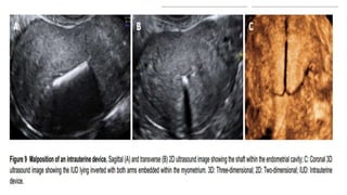 IUCD
– Location of intrauterine
contraceptive devices:
displacement of intrauterine
contraceptive devices can
reduce their effectiveness.
The coronal plane images
provided by 3D ultrasound
provide views of both the
arms and shaft of the device
and the relation of these to
the endometrial cavity.
 