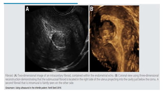 FIBROID
• 3D ultrasound has recently been
used to map the exact location of
fibroids in relation to the
endometrial cavity and
surrounding structures.
• This is extremely important in
triaging patients for surgery and
• Potentially useful in monitoring the
reduction in the size of fibroids in
patients receiving gonadotrophin-
releasing hormone analogs or
following uterine artery
embolization.
 