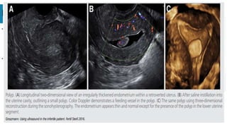ENDOMETRIAL POLYPS
- Assessing whether or not a
patient has an endometrial
polyp and then determine the
size of the polyp and its pedicle.
-Studies have demonstrated that
the uterine cavity, endometrial
lining and myometrium are best
visualized using
sonohysterography, and that
these images are further
improved by the use of 3D
ultrasound.
 