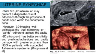 UTERINE SYNECHIAE
-With SIS ,2D ultrasound may
present a diagnostic clue of
adhesions through the presence of
bands seen within the endometrial
echo.
-However, 3D imaging well
delineates the true narrowing or
“bands” adherent across the cavity
-3D ultrasound has better sensitivity
and predicted adhesions and cavity
damage with greater accuracy than
HSG in patients with suspected
Asherman’s syndrome. (Knop man et
al)
 