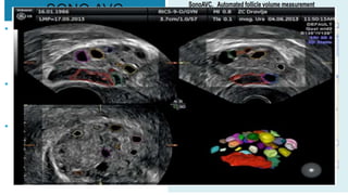 SONO AVC
• SONO AVC is a 3D software with
automated calculation the no. of
follicles in individual ovaries and
gives good count assessment.
• Very useful for antral follicle
count assessment in IVF
protocols.
• For diagnosis of PCOS and early
prediction of ovarian
hyperstimulation when 3D
doppler is employed alongside
 