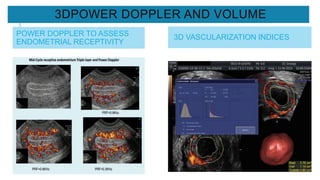 3DPOWER DOPPLER AND VOLUME
POWER DOPPLER TO ASSESS
ENDOMETRIAL RECEPTIVITY
3D VASCULARIZATION INDICES
 