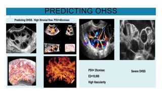 PREDICTING OHSS
 