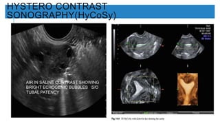 HYSTERO CONTRAST
SONOGRAPHY(HyCoSy)
AIR IN SALINE CONTRAST SHOWING
BRIGHT ECHOGENIC BUBBLES S/O
TUBAL PATENCY
 