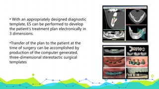 • With an appropriately designed diagnostic
template, ES can be performed to develop
the patient’s treatment plan electronically in
3 dimensions.
•Transfer of the plan to the patient at the
time of surgery can be accomplished by
production of the computer generated,
three-dimensional stereotactic surgical
templates
 