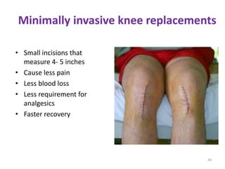 Recent advances in joint arthroplasty | PPTX