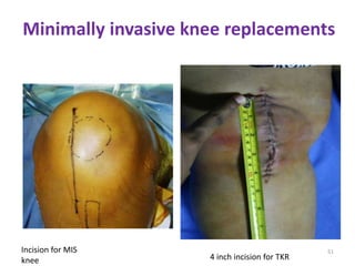 Recent advances in joint arthroplasty | PPTX