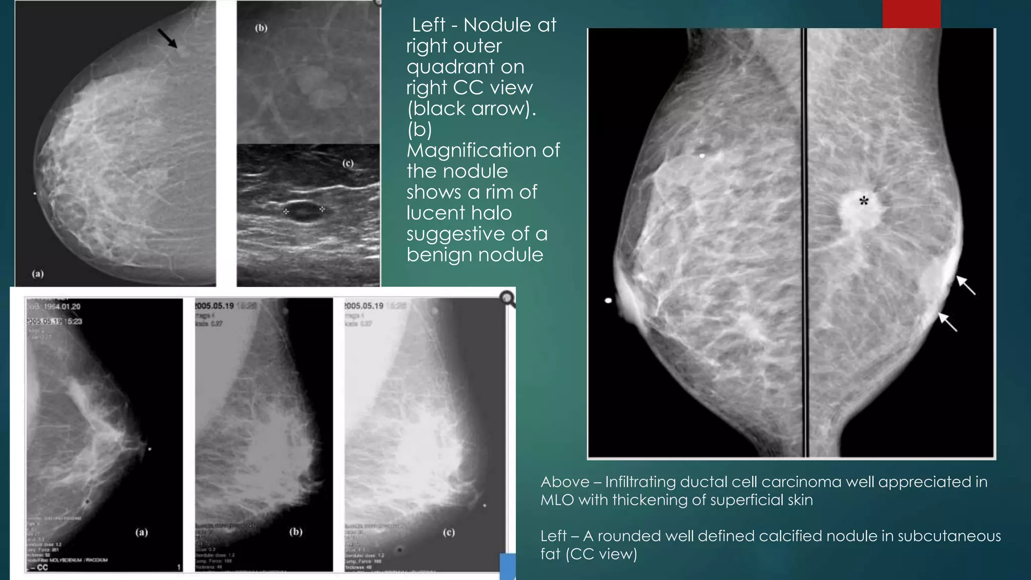 Recent advances in Mammography | PPTX