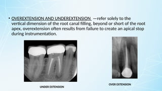 • OVEREXTENSION AND UNDEREXTENSION —refer solely to the
vertical dimension of the root canal filling, beyond or short of the root
apex, overextension often results from failure to create an apical stop
during instrumentation.
OVER EXTENSION
UNDER EXTENSION
 