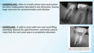 • UNDERFILLING- refers to a tooth whose root canal system
has been inadequately obturated in any dimension, leaving
large reservoirs for recontamination and infection
• OVERFILLING –A solid or semi-solid core root canal filling
extending beyond the apical foramen; commonly used to
imply that the root canal space is completely obturated.
 