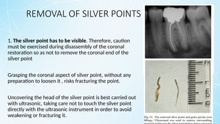 REMOVAL OF SILVER POINTS
1. The silver point has to be visible. Therefore, caution
must be exercised during disassembly of the coronal
restoration so as not to remove the coronal end of the
silver point
Grasping the coronal aspect of silver point, without any
preparation to loosen it , risks fracturing the point.
Uncovering the head of the silver point is best carried out
with ultrasonic, taking care not to touch the silver point
directly with the ultrasonic instrument in order to avoid
weakening or fracturing it.
 