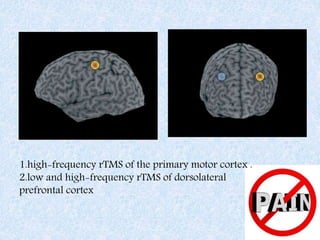 1.high-frequency rTMS of the primary motor cortex .
2.low and high-frequency rTMS of dorsolateral
prefrontal cortex
 