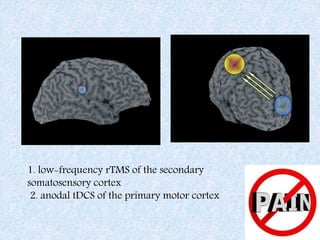 1. low-frequency rTMS of the secondary
somatosensory cortex
2. anodal tDCS of the primary motor cortex
 
