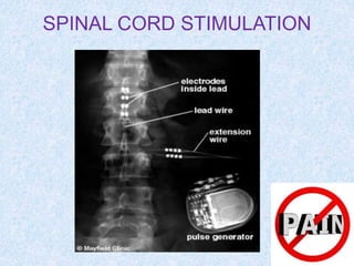 SPINAL CORD STIMULATION
 
