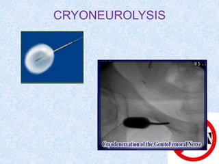 CRYONEUROLYSIS
 