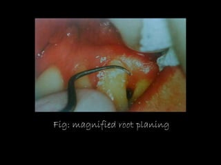 Recent advances in periodontal surgical technology | PPTX