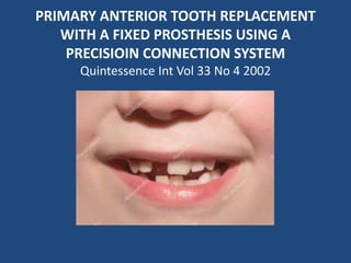 PRIMARY ANTERIOR TOOTH REPLACEMENT
WITH A FIXED PROSTHESIS USING A
PRECISIOIN CONNECTION SYSTEM
Quintessence Int Vol 33 No 4 2002
 