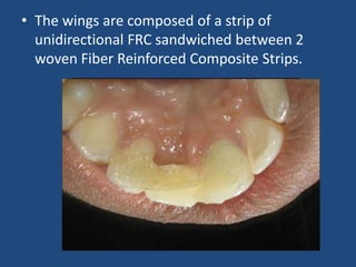 • The wings are composed of a strip of
unidirectional FRC sandwiched between 2
woven Fiber Reinforced Composite Strips.
 