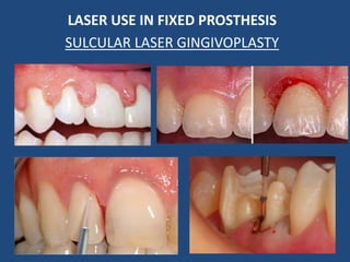 LASER USE IN FIXED PROSTHESIS
SULCULAR LASER GINGIVOPLASTY
 