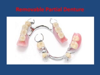 Removable Partial Denture
 