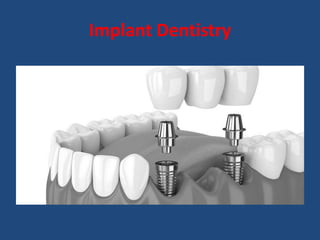 Implant Dentistry
 