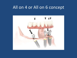 All on 4 or All on 6 concept
 