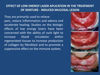 EFFECT OF LOW ENERGY LASER APLICATION IN THE TREATMENT
OF DENTURE - INDUCED MUCOSAL LESION
They are primarily used to relieve
pain, reduce inflammation and edema and
accelerate healing. Studies on the biologic
effects of low energy lasers have been
concerned with the ability of such light to
increase blood circulation within
regenerated tissues to increase production
of collagen by fibroblast and to promote a
suppressive effect on the immune system.
 