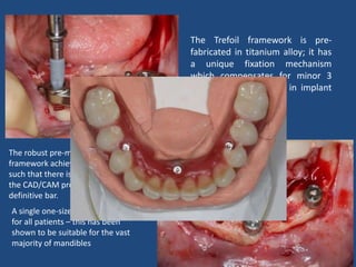The Trefoil framework is pre-
fabricated in titanium alloy; it has
a unique fixation mechanism
which compensates for minor 3
dimensional deviations in implant
placement.
The robust pre-manufactured
framework achieves a passive fit,
such that there is then no need for
the CAD/CAM production of a
definitive bar.
A single one-size framework is used
for all patients – this has been
shown to be suitable for the vast
majority of mandibles
 