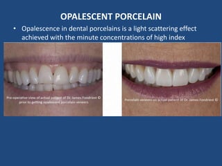 OPALESCENT PORCELAIN
• Opalescence in dental porcelains is a light scattering effect
achieved with the minute concentrations of high index
refraction oxides in a size range near the wavelength of visible
light.
• Opalescent porcelain is a specific type of porcelain that offers
more brightness, compared to traditional porcelain. This
porcelain also allows the lab technician to add intrinsic stains
commonly found in natural teeth. The subtle stains and incisal
translucency added, are what make an opalescent porcelain
veneer look believably natural.
 