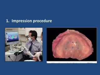 1. Impression procedure
 