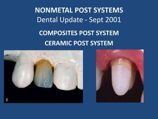 NONMETAL POST SYSTEMS
Dental Update - Sept 2001
COMPOSITES POST SYSTEM
CERAMIC POST SYSTEM
 