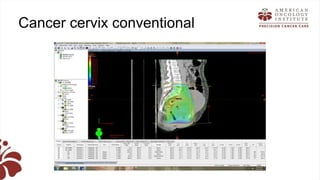 Recent advances in radiation oncology final (1) | PPTX