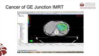 Recent advances in radiation oncology final (1) | PPTX