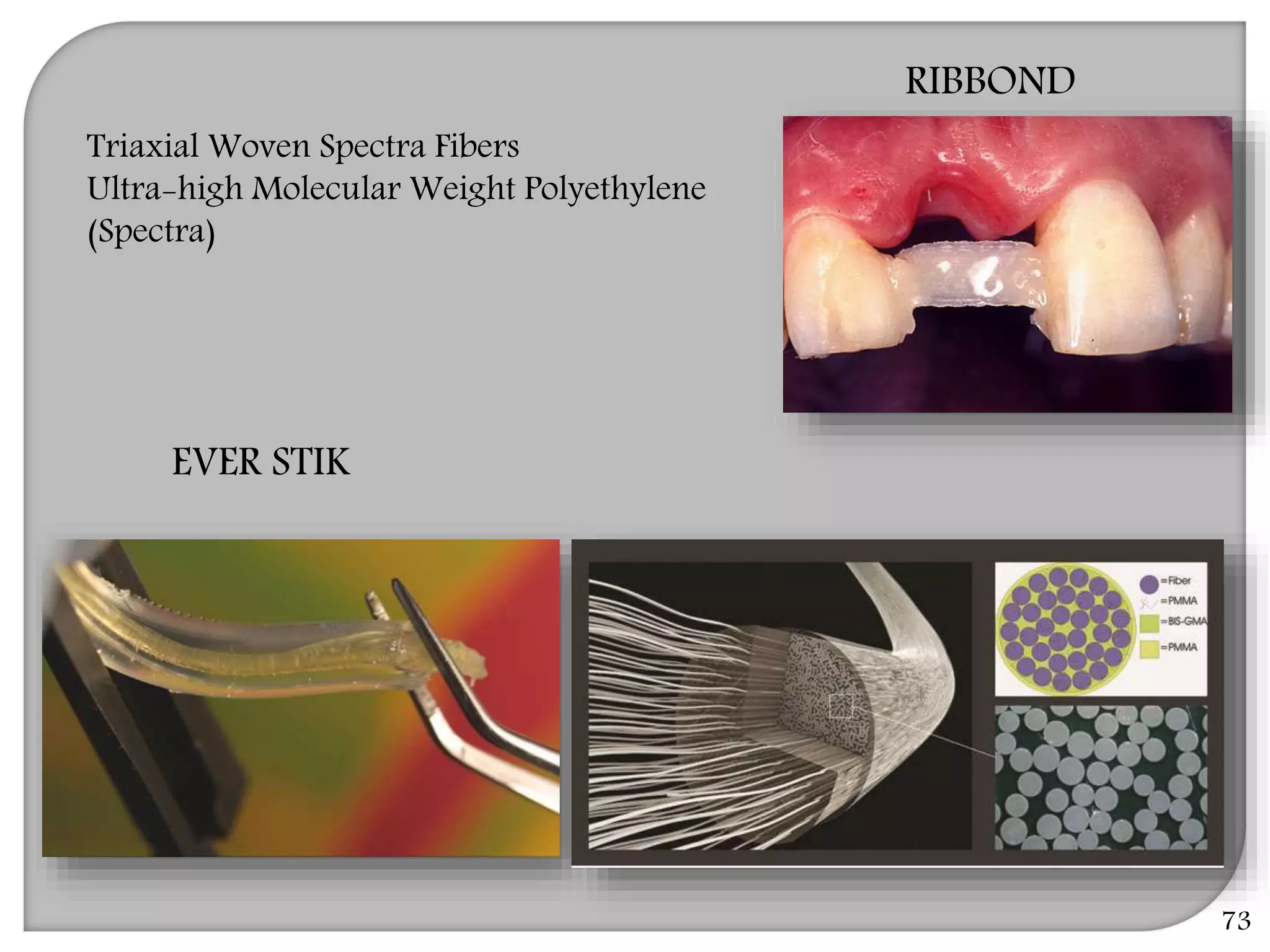 Triaxial Woven Spectra Fibers
Ultra-high Molecular Weight Polyethylene
(Spectra)
RIBBOND
EVER STIK
73
 