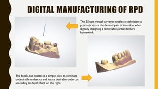 DIGITAL MANUFACTURING OF RPD
The 3Shape virtual surveyor enables a technician to
precisely locate the desired path of insertion when
digitally designing a removable partial denture
framework.
The block-out process is a simple click to eliminate
undesirable undercuts and locate desirable undercuts
according to depth chart on the right.
 