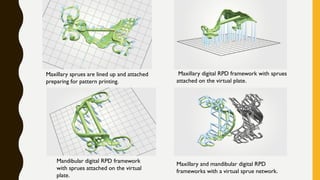 Maxillary sprues are lined up and attached
preparing for pattern printing.
Maxillary digital RPD framework with sprues
attached on the virtual plate.
Mandibular digital RPD framework
with sprues attached on the virtual
plate.
Maxillary and mandibular digital RPD
frameworks with a virtual sprue network.
 