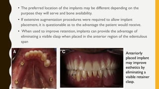 • The preferred location of the implants may be different depending on the
purpose they will serve and bone availability.
• If extensive augmentation procedures were required to allow implant
placement, it is questionable as to the advantage the patient would receive.
• When used to improve retention, implants can provide the advantage of
eliminating a visible clasp when placed in the anterior region of the edentulous
span
Anteriorly
placed implant
may improve
esthetics by
eliminating a
visible retainer
clasp.
 