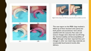 This case report on the PEEK clasp involved a
follow-up of short duration (two years), but
both patient and practitioner were almost
satisﬁed with the outcome. Few color and
texture changes were observed, reconﬁrming
the chemical stability and biocompatibility of
PEEK, although it has been reported that such
changes in other non metal clasp materials are
occasionally found several months after
delivery.
 