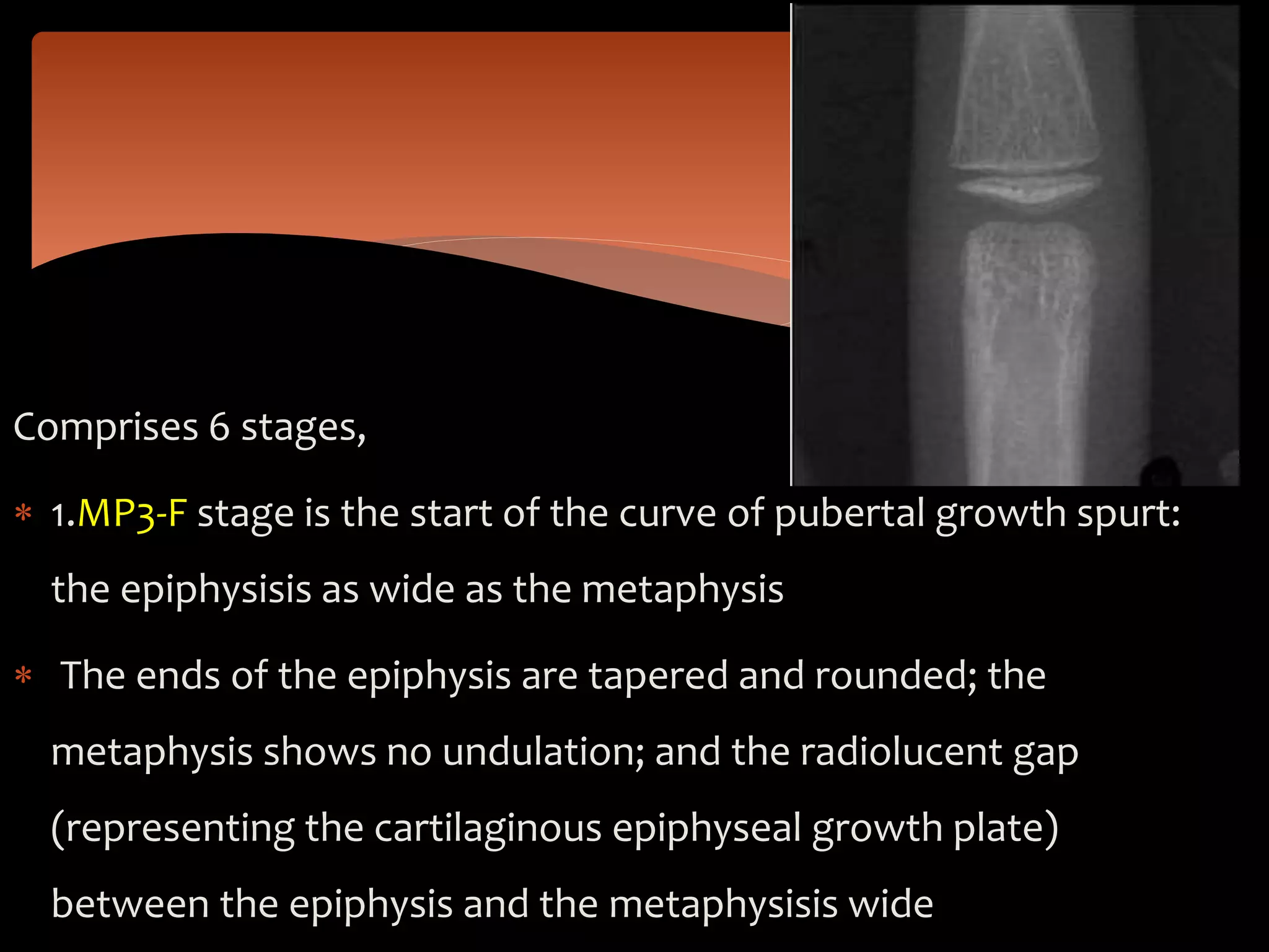 Comprises 6 stages,
 1.MP3-F stage is the start of the curve of pubertal growth spurt:
the epiphysisis as wide as the metaphysis
 The ends of the epiphysis are tapered and rounded; the
metaphysis shows no undulation; and the radiolucent gap
(representing the cartilaginous epiphyseal growth plate)
between the epiphysis and the metaphysisis wide
 