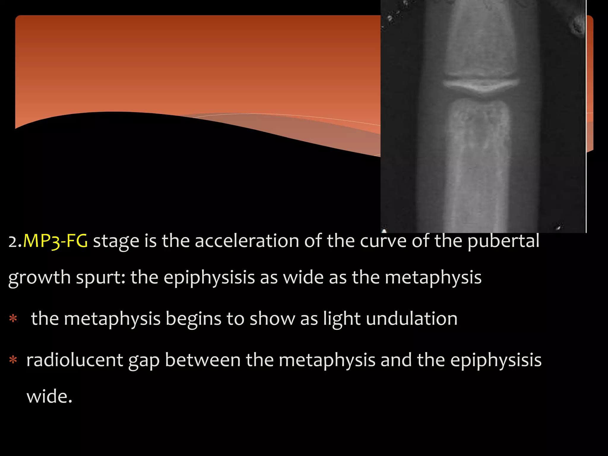 2.MP3-FG stage is the acceleration of the curve of the pubertal
growth spurt: the epiphysisis as wide as the metaphysis
 the metaphysis begins to show as light undulation
 radiolucent gap between the metaphysis and the epiphysisis
wide.
 