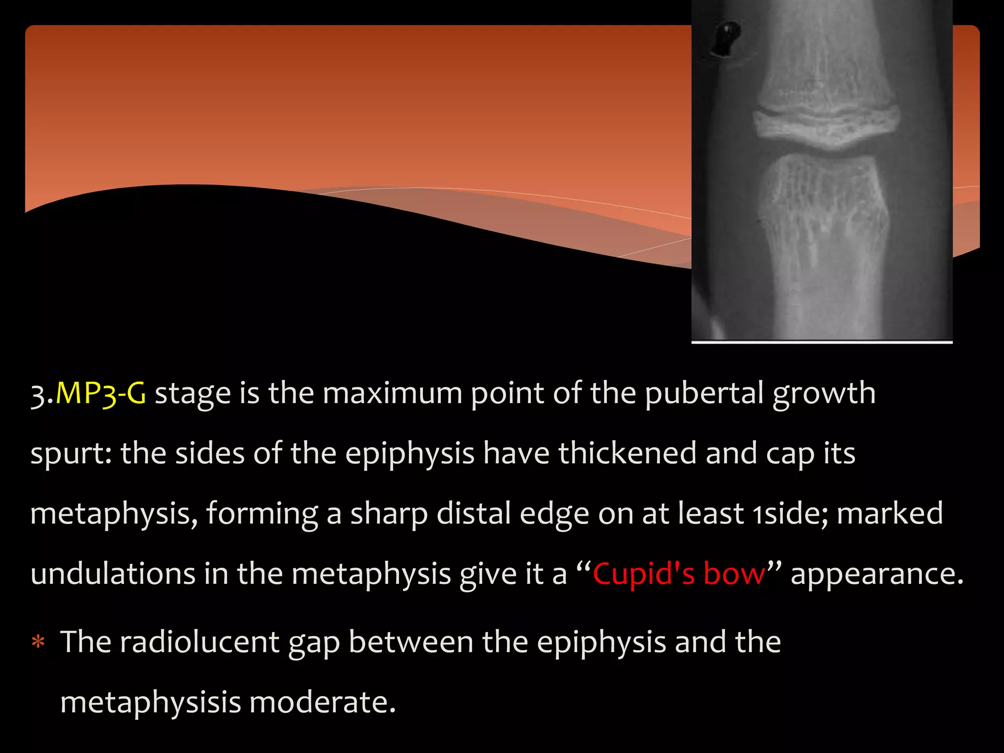 3.MP3-G stage is the maximum point of the pubertal growth
spurt: the sides of the epiphysis have thickened and cap its
metaphysis, forming a sharp distal edge on at least 1side; marked
undulations in the metaphysis give it a “Cupid's bow” appearance.
 The radiolucent gap between the epiphysis and the
metaphysisis moderate.
 
