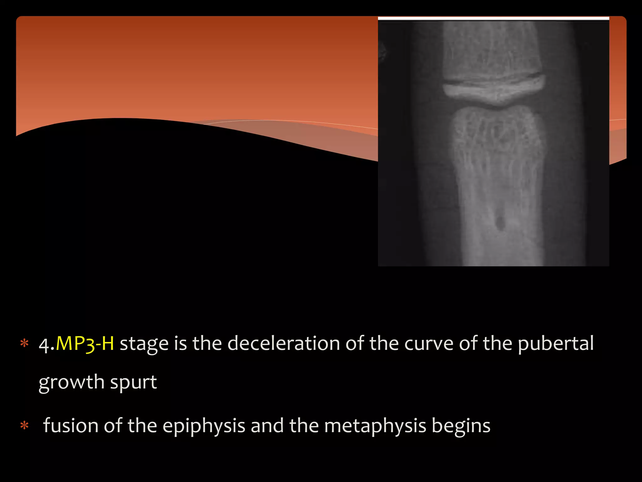  4.MP3-H stage is the deceleration of the curve of the pubertal
growth spurt
 fusion of the epiphysis and the metaphysis begins
 